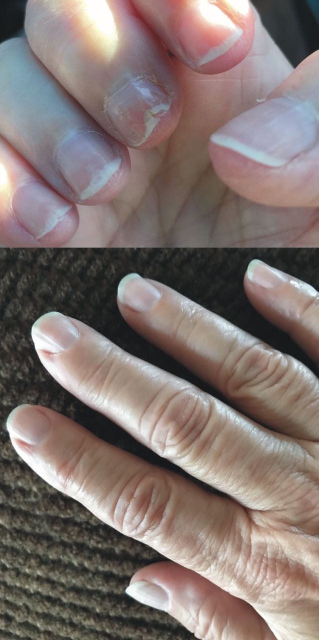 Before and After Using FlexiNail